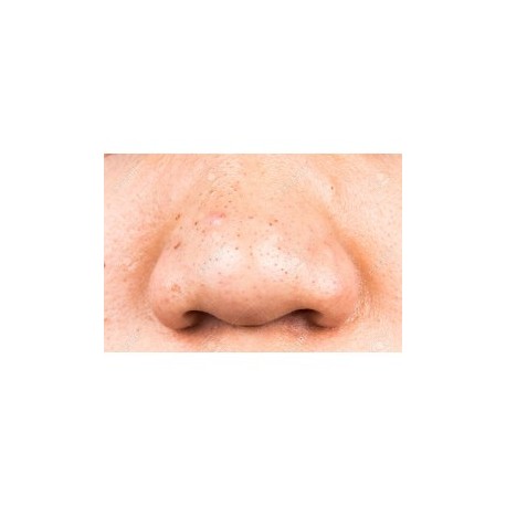 GEL ANTI-ACNÉ